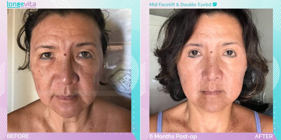 Eyelid and Mid Facelift before and after, Face