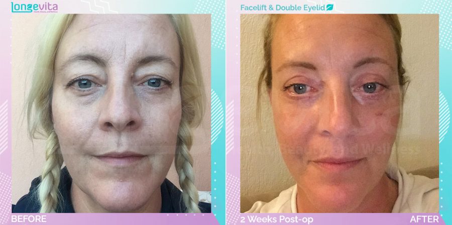 Eyelid and Facelift before and after, Face
