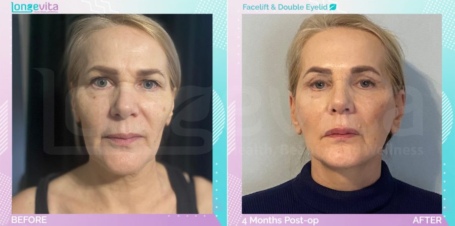 Eyelid and Facelift before and after, Face, 50s female patient