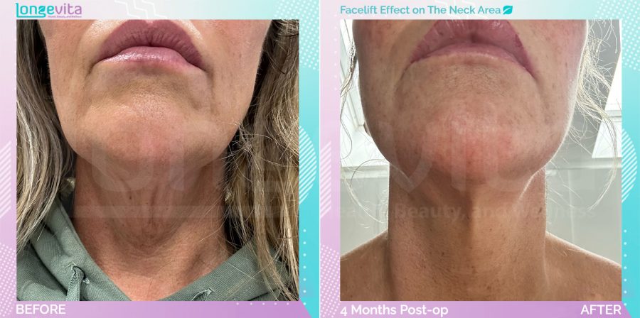 Facelift before and after, Face, 50s female patient