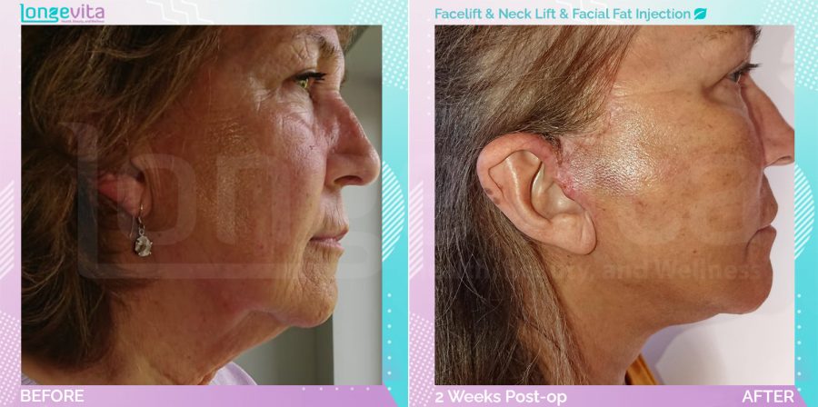 Facelift and Facial Fat Injection and Neck Lift before and after, Face, 60s female patient