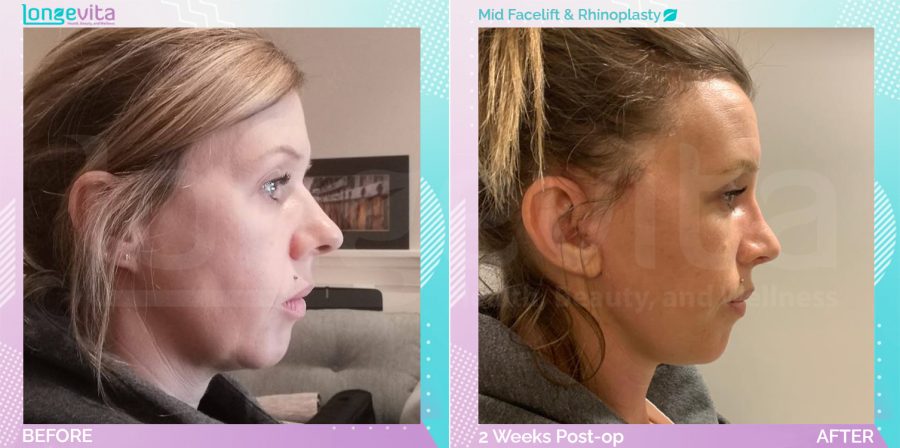 Mid Facelift and Rhinoplasty before and after, Face, 30s female patient