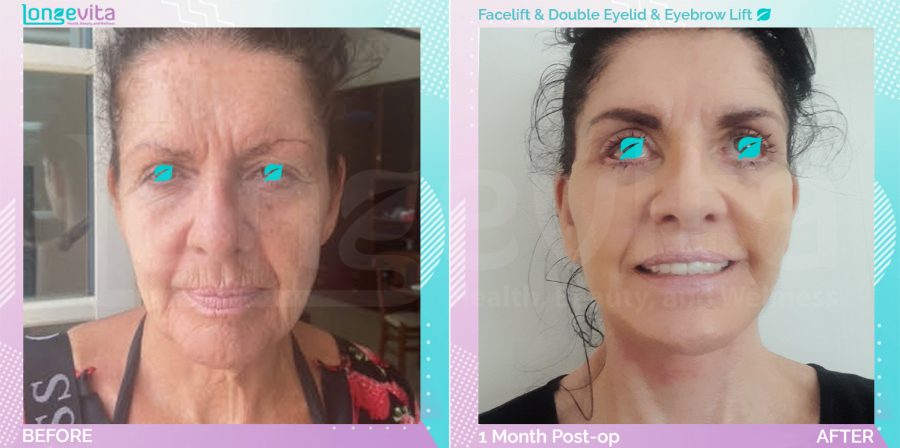 Eyebow Lift and Eyelid and Facelift before and after, Face, 60s female patient