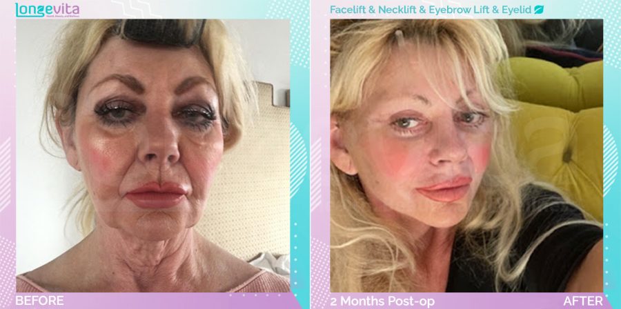 Eyebow Lift and Eyelid and Facelift and Neck Lift before and after, Face, 60s female patient
