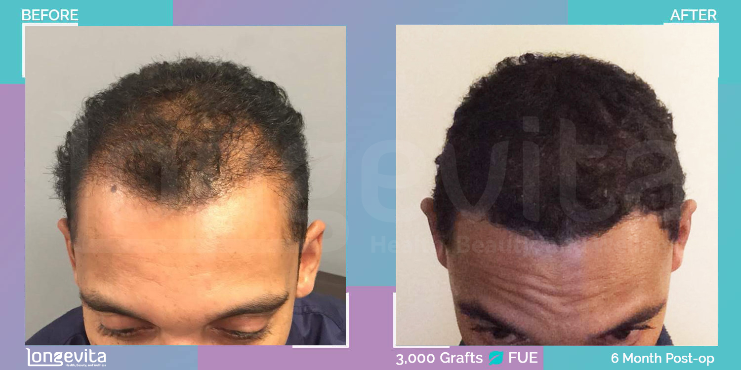 FUE hair transplant before and after, 3000 grafts, 4 zones covered, 40s male patient