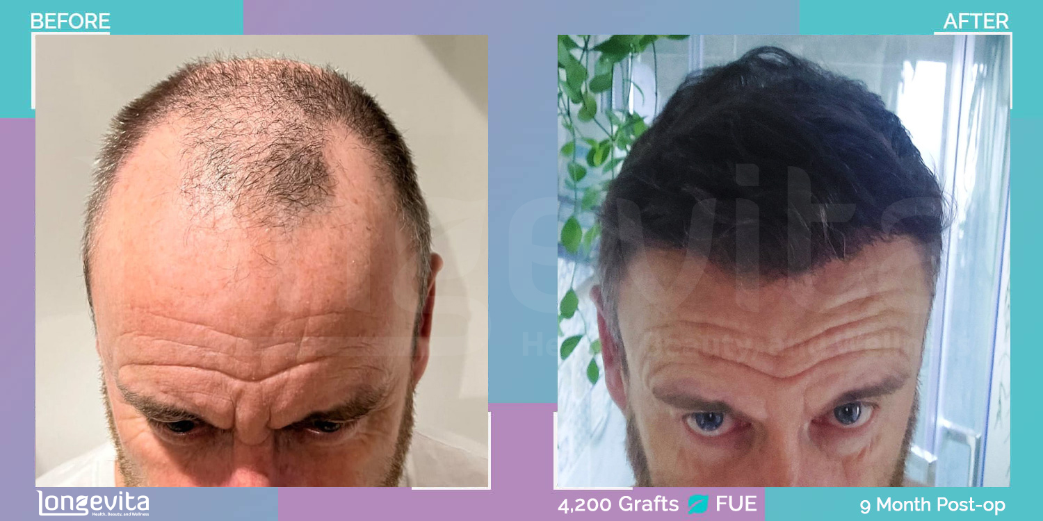 FUE hair transplant before and after, 4200 grafts, 3 zones covered, 50s male patient