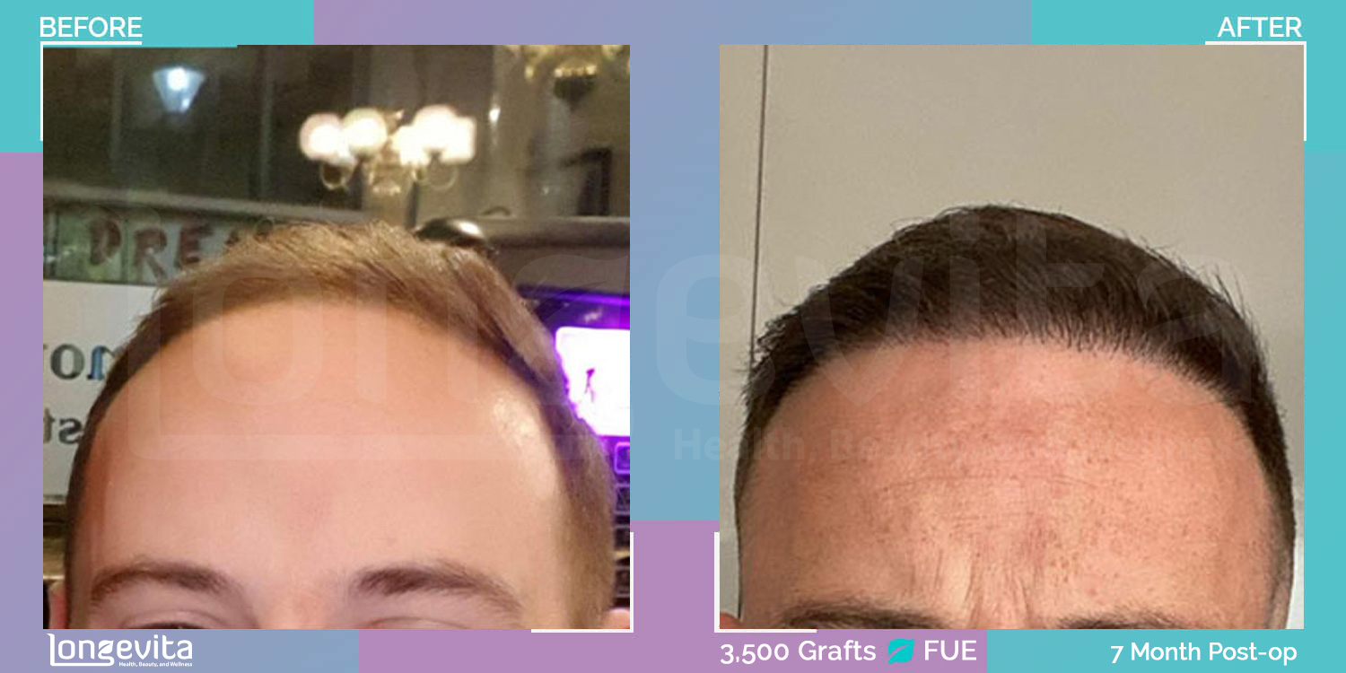 FUE hair transplant before and after, 3500 grafts, 2 zones covered, 30s male patient