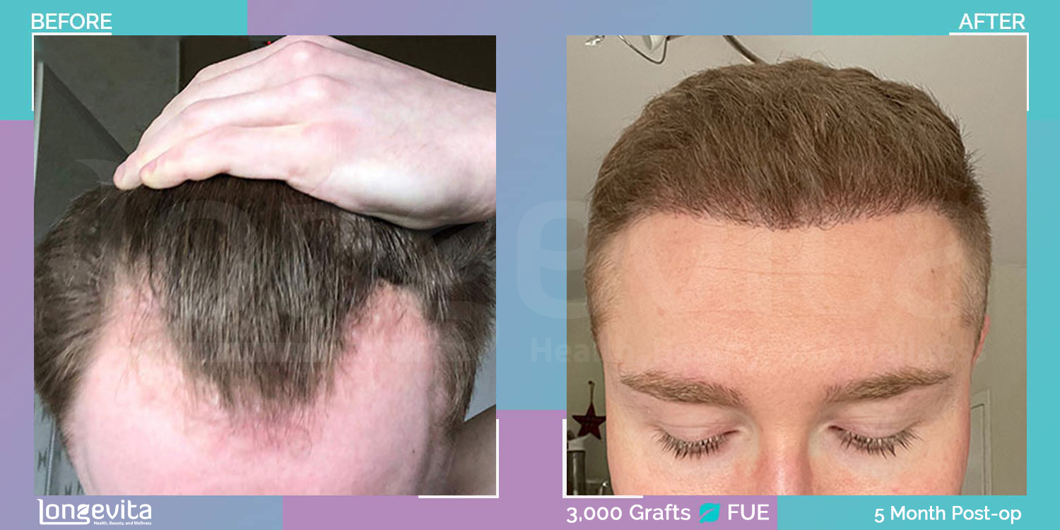 FUE hair transplant before and after, 3000 grafts, 3 zones covered, 20s male patient