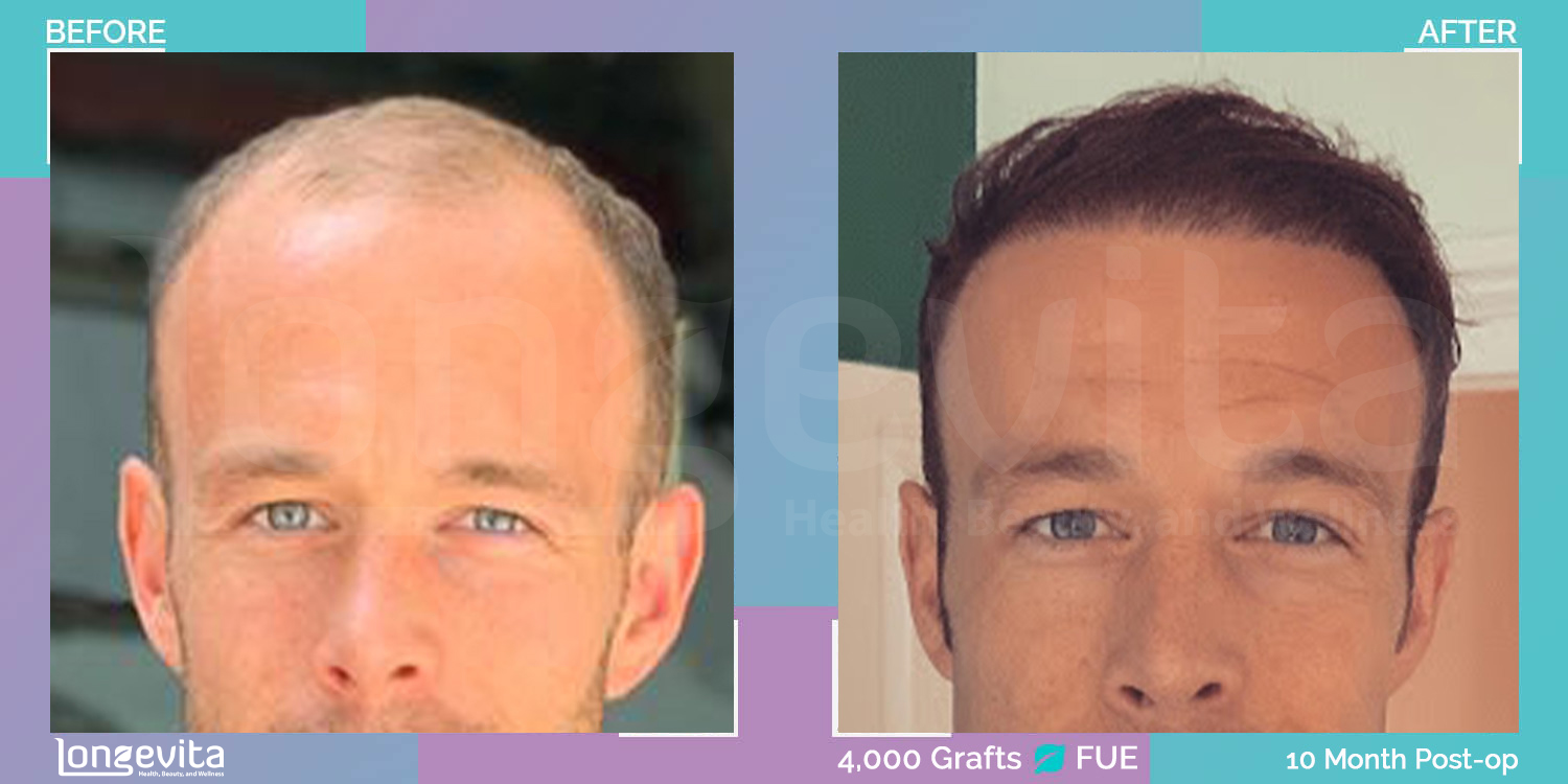 FUE hair transplant before and after, 4000 grafts, 6 zones covered, 30s male patient