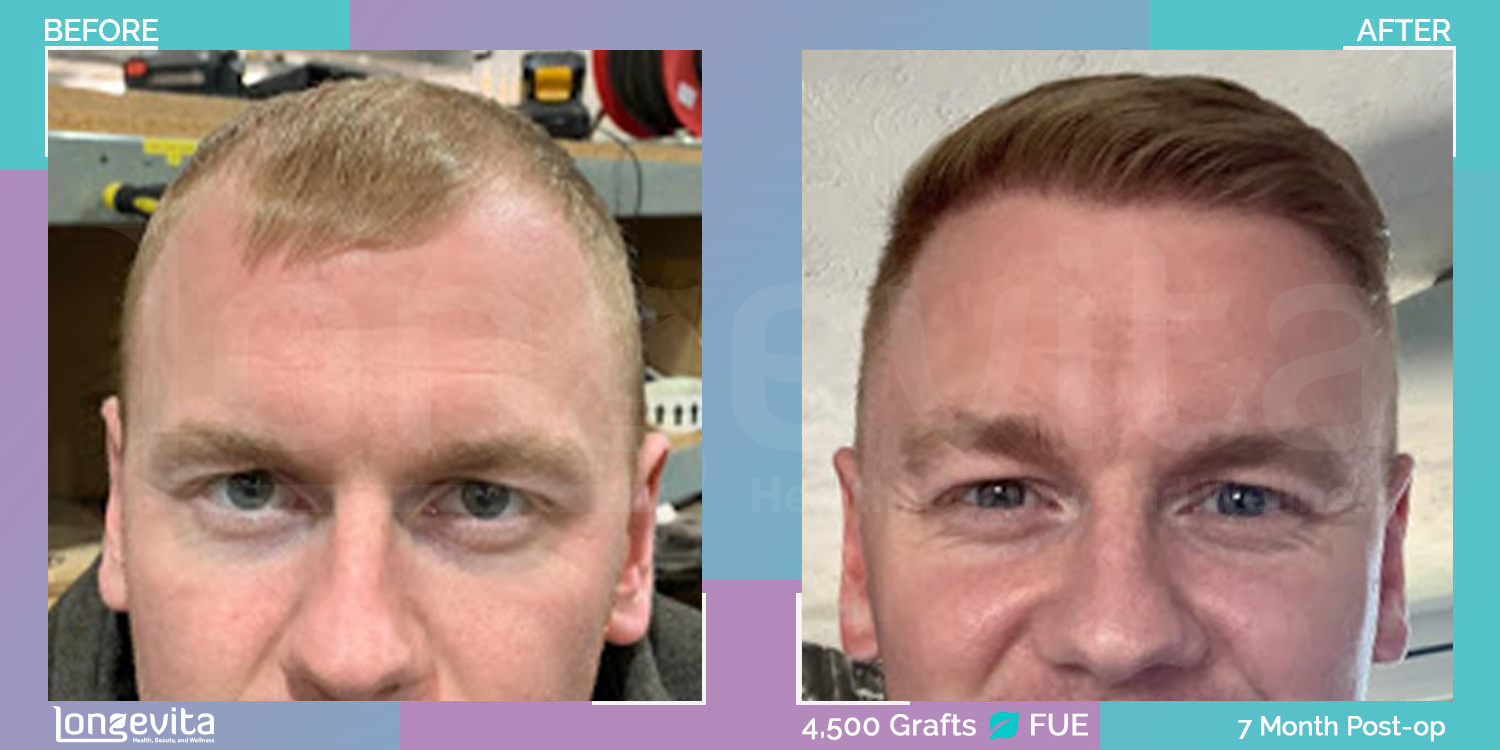 FUE hair transplant before and after, 4500 grafts, 6 zones covered, 20s male patient