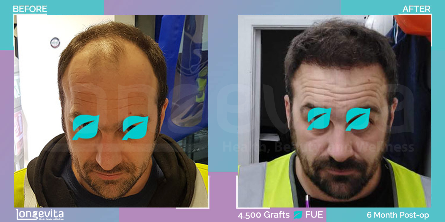 FUE hair transplant before and after, 4500 grafts, 5 zones covered