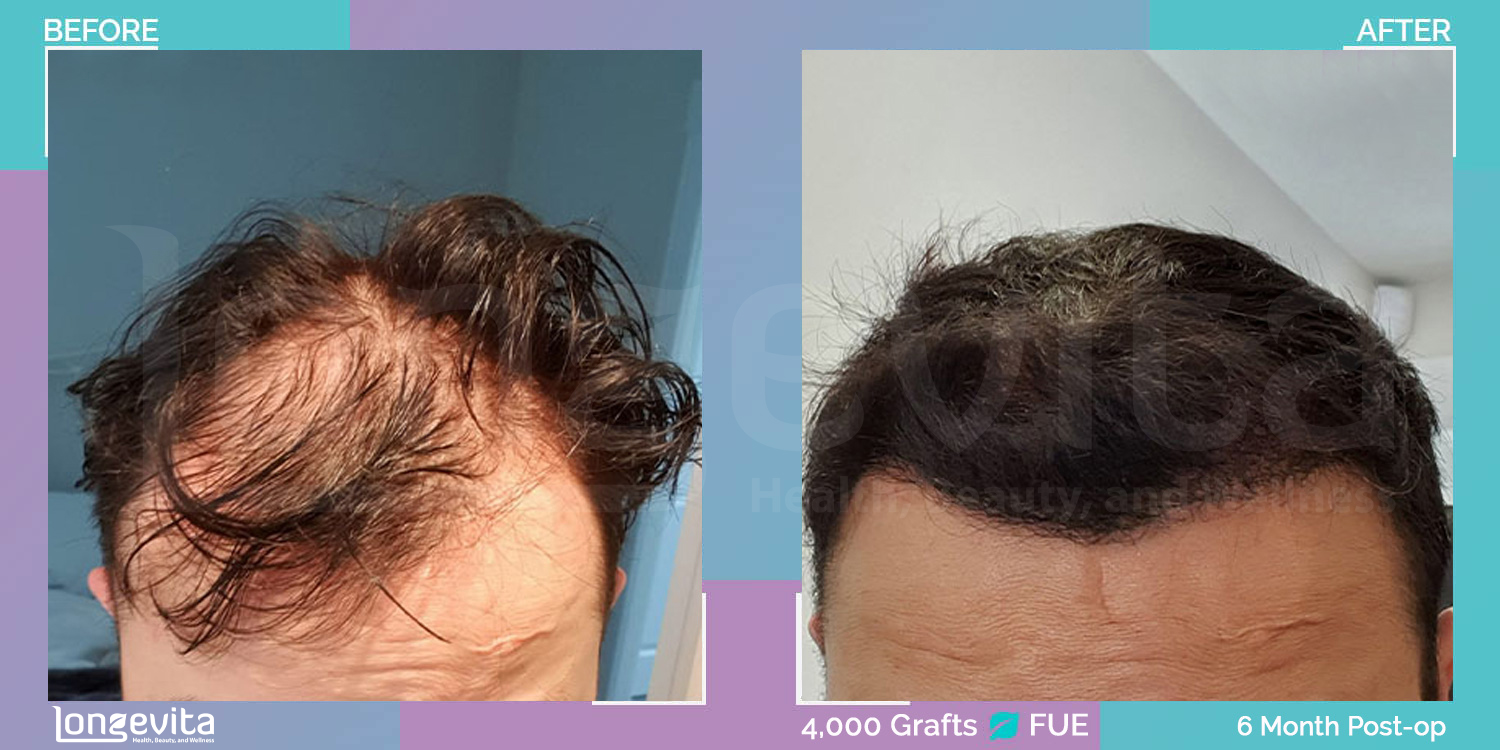 FUE hair transplant before and after, 4000 grafts, 6 zones covered, 30s male patient