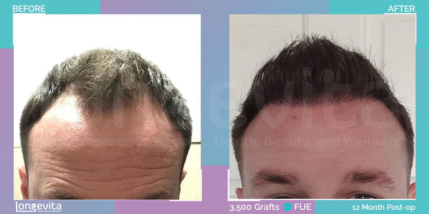 FUE hair transplant before and after, 1500 grafts, 3 zones covered, 30s male patient