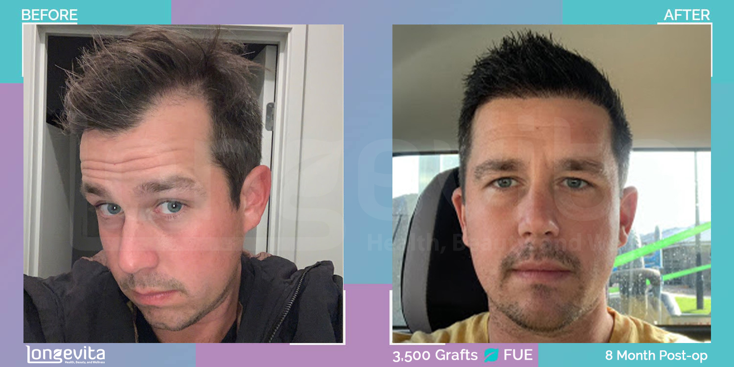 FUE hair transplant before and after, 3500 grafts, 4 zones covered, 30s male patient