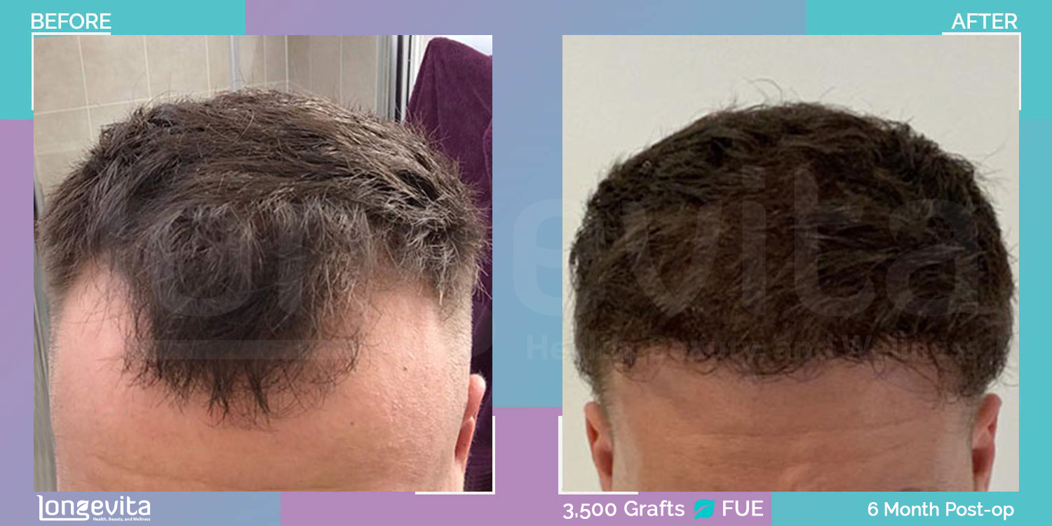 FUE hair transplant before and after, 3500 grafts, 3 zones covered, 20s male patient