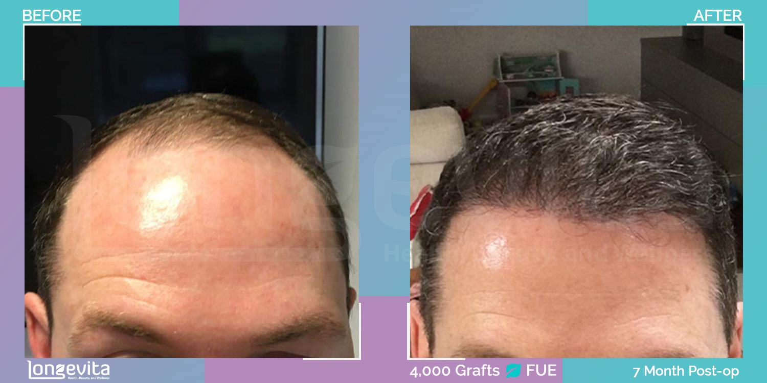 FUE hair transplant before and after, 4000 grafts, 6 zones covered, 30s male patient