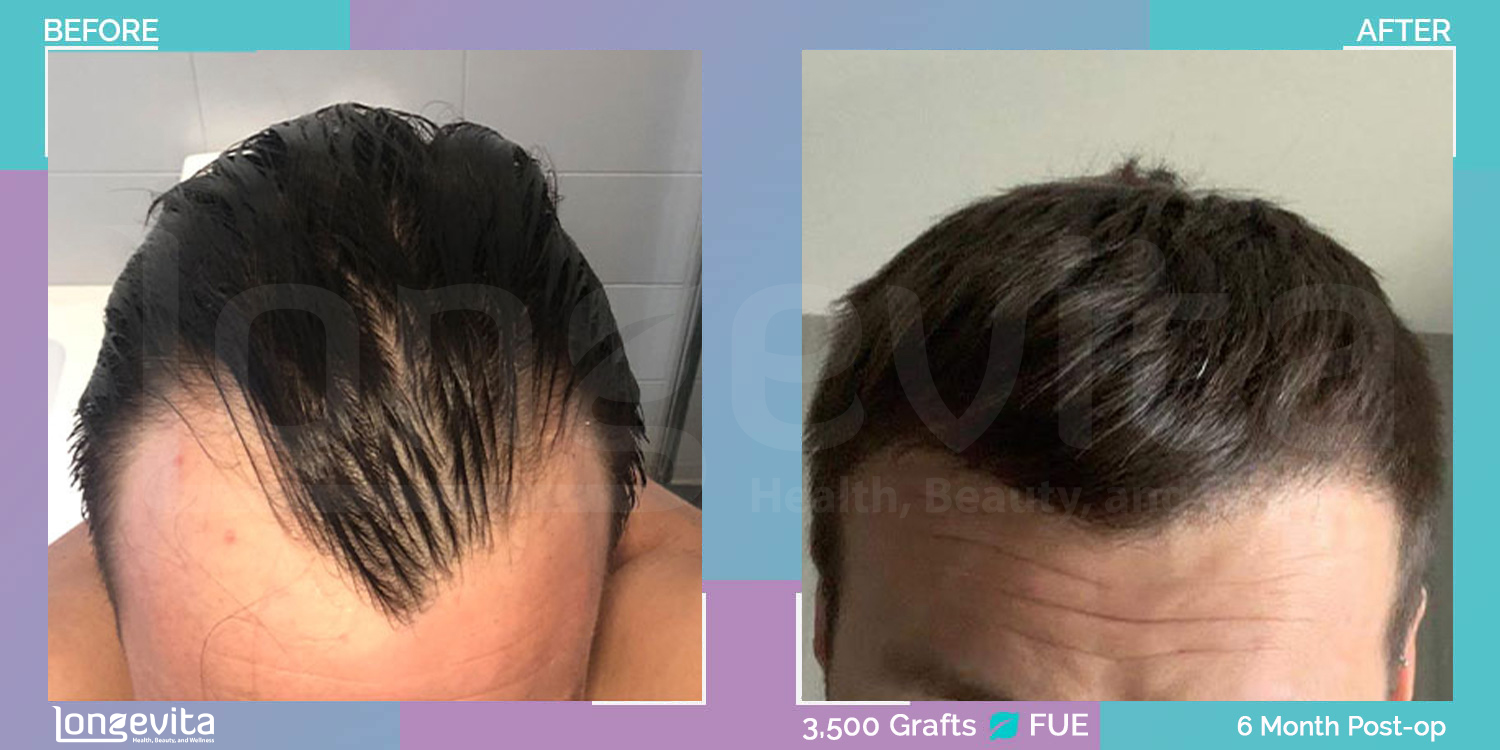 FUE hair transplant before and after, 3500 grafts, 3 zones covered