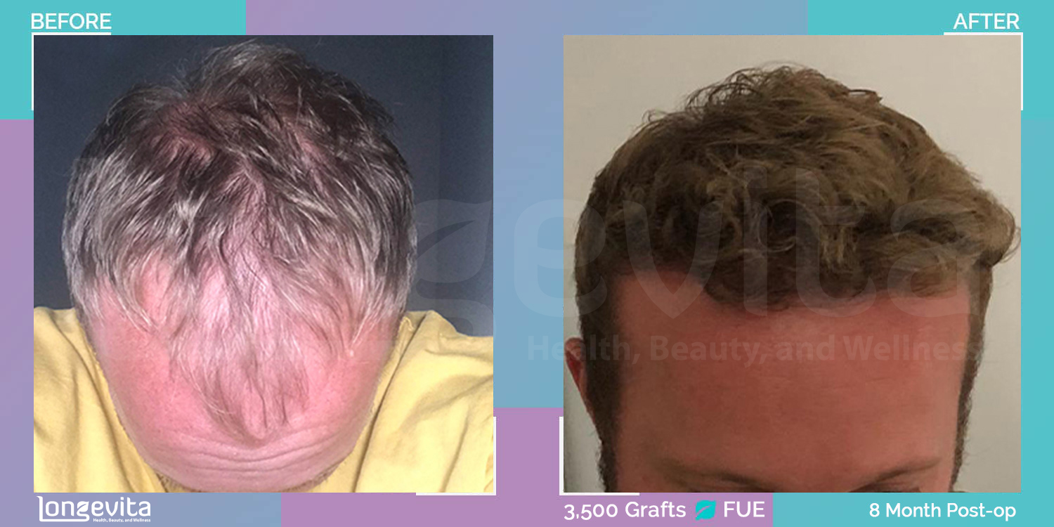 FUE hair transplant before and after, 3500 grafts, 6 zones covered, 20s male patient