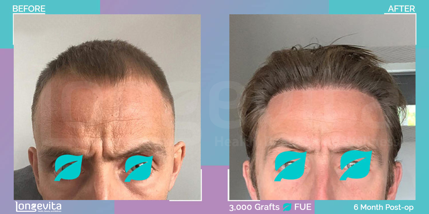 FUE hair transplant before and after, 3000 grafts, 3 zones covered, 30s male patient
