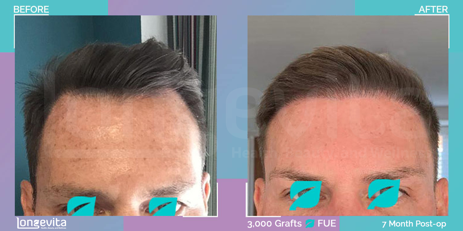 FUE hair transplant before and after, 3000 grafts, 3 zones covered, 40s male patient