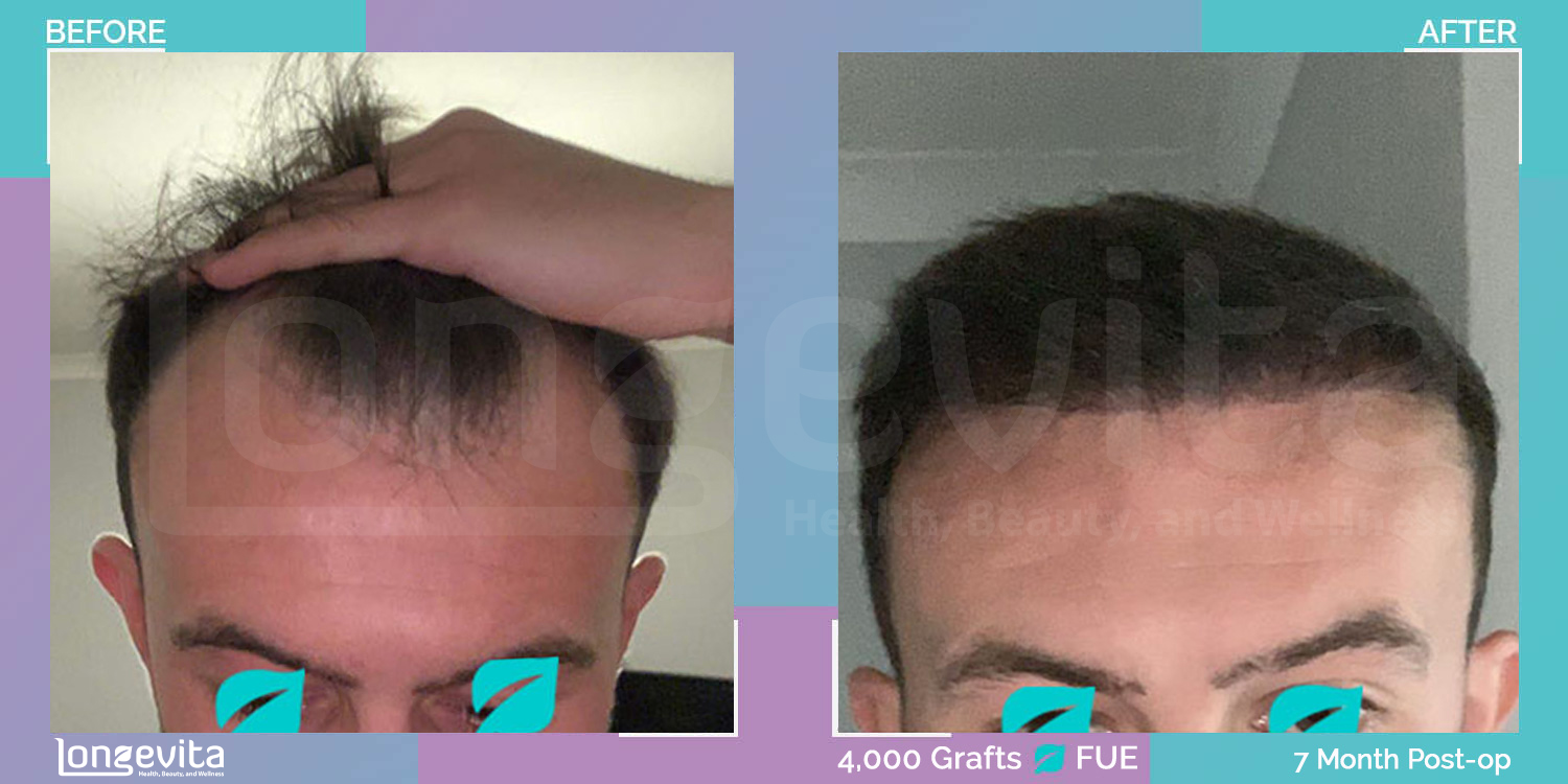 FUE hair transplant before and after, 4000 grafts, 3 zones covered, 20s male patient