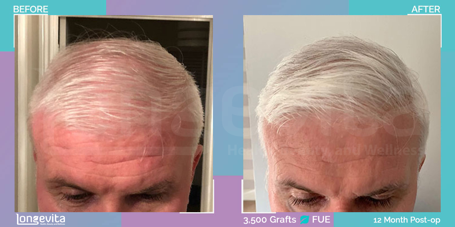 FUE hair transplant before and after, 3500 grafts, 3 zones covered, 40s male patient