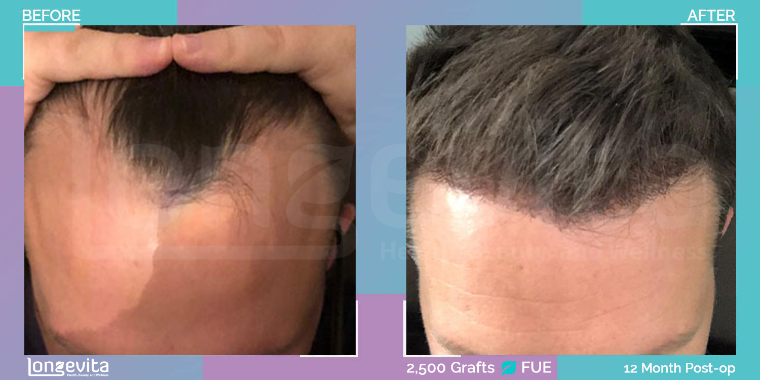 FUE hair transplant before and after, 2500 grafts, 3 zones covered, 30s male patient