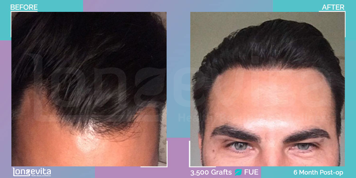 FUE hair transplant before and after, 3500 grafts, 2 zones covered, 30s male patient