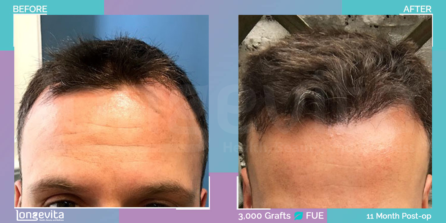 FUE hair transplant before and after, 3000 grafts, 3 zones covered, 20s male patient