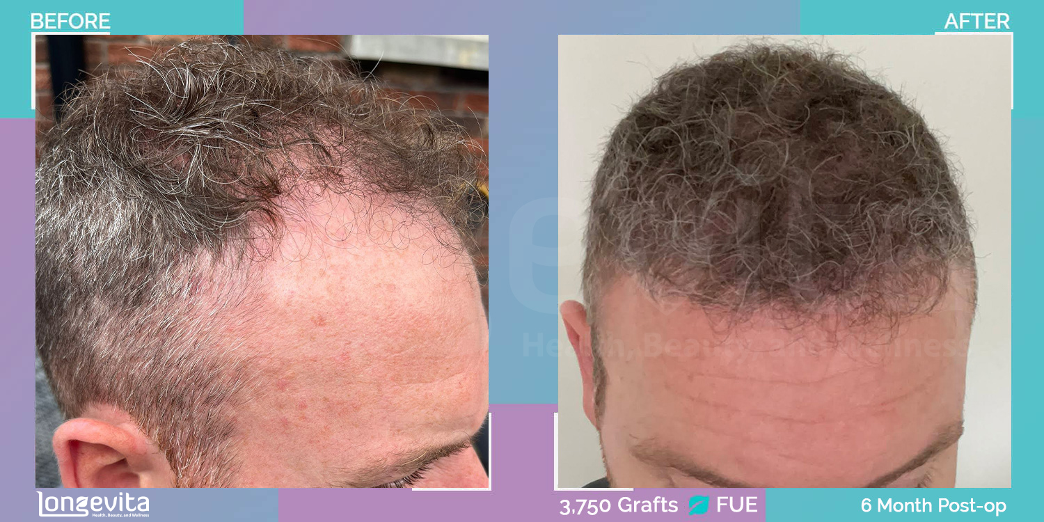 FUE hair transplant before and after, 3750 grafts, 3 zones covered, 40s male patient