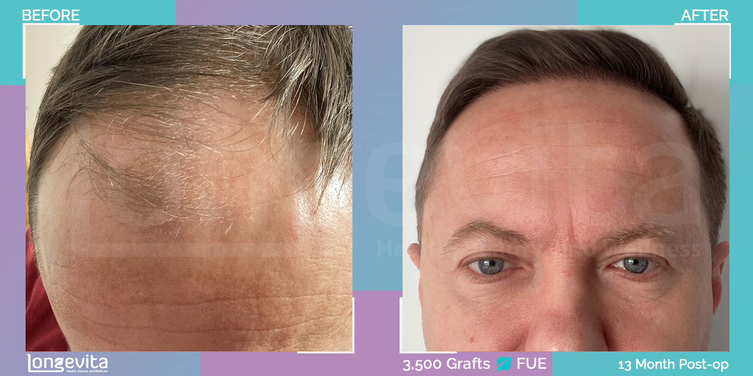 FUE hair transplant before and after, 3500 grafts, 2 zones covered, 40s male patient