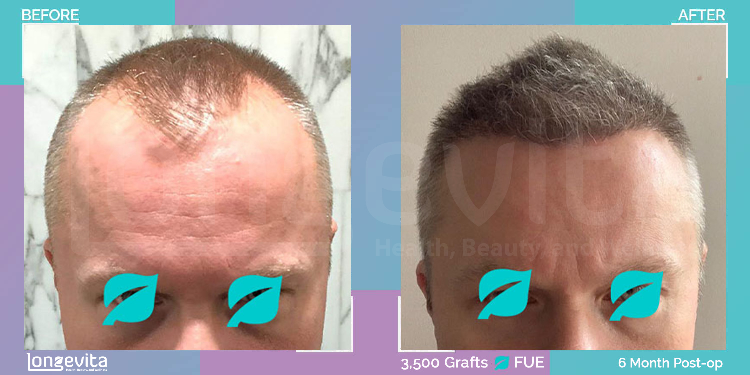 FUE hair transplant before and after, 3500 grafts, 6 zones covered