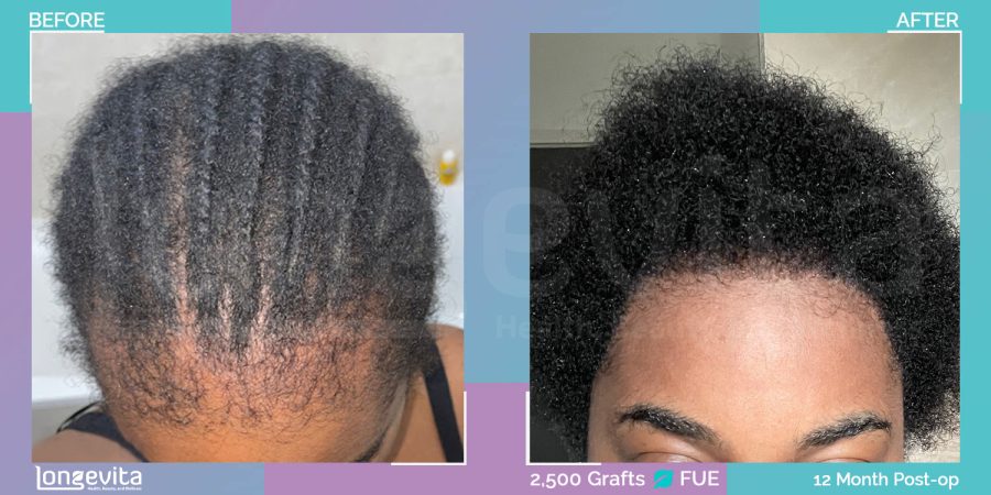 FUE hair transplant before and after, 2500 grafts, 2 zones covered, 30s female patient