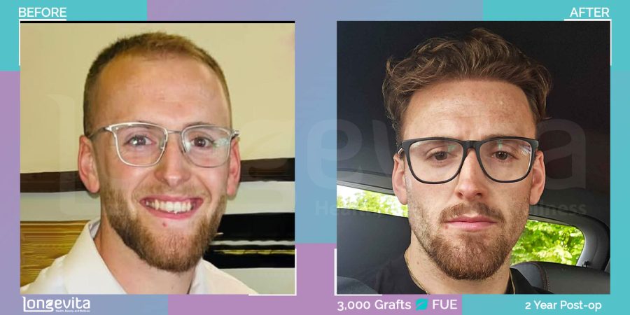 FUE hair transplant before and after, 3000 grafts, 1 zone covered, 20s male patient