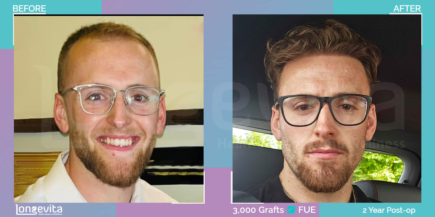 FUE hair transplant before and after, 3000 grafts, 1 zone covered, 20s male patient