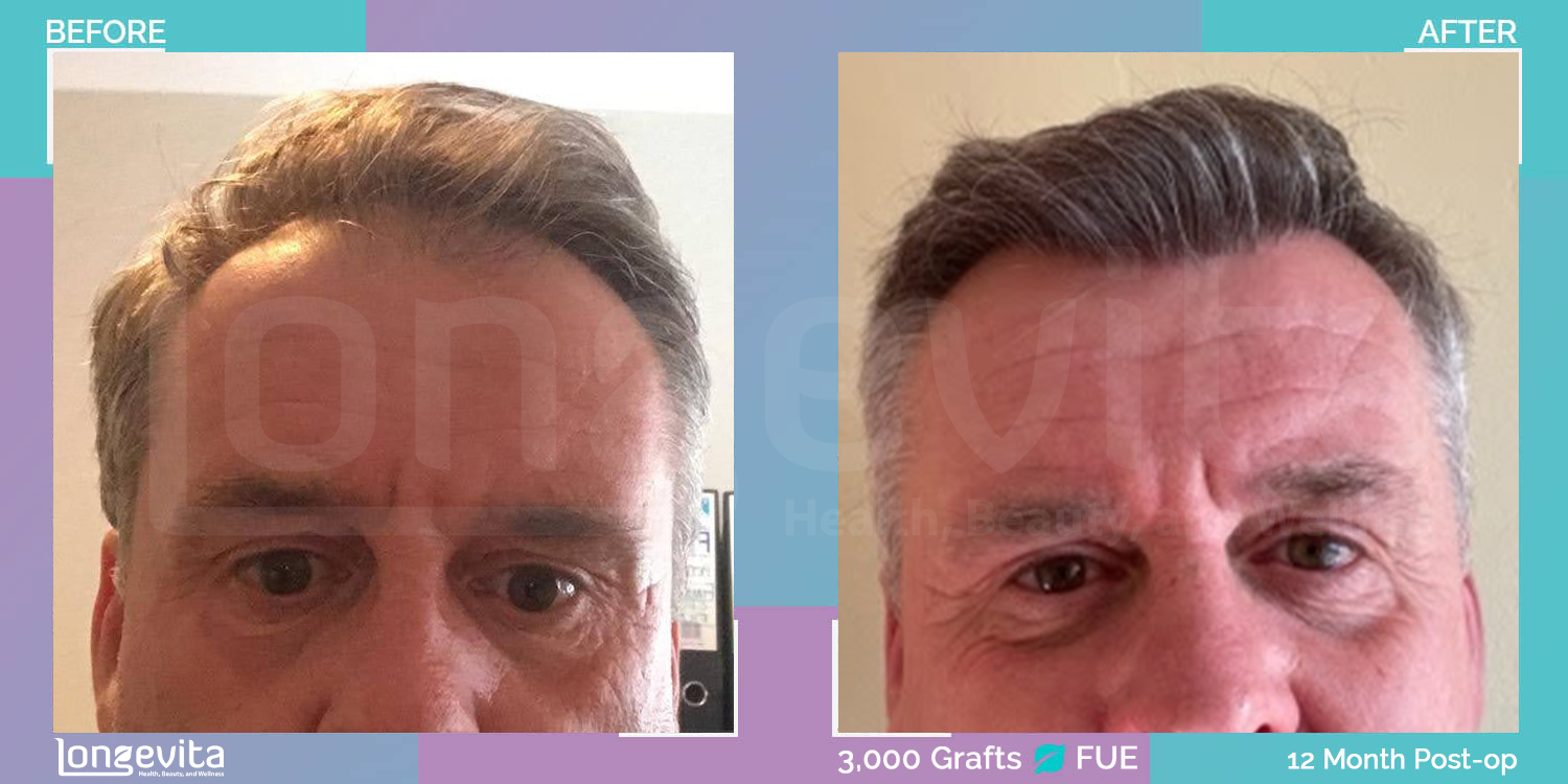 FUE hair transplant before and after, 3000 grafts, 4 zones covered, 50s male patient