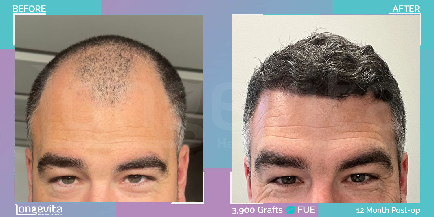 FUE hair transplant before and after, 3900 grafts, 6 zones covered, 30s male patient