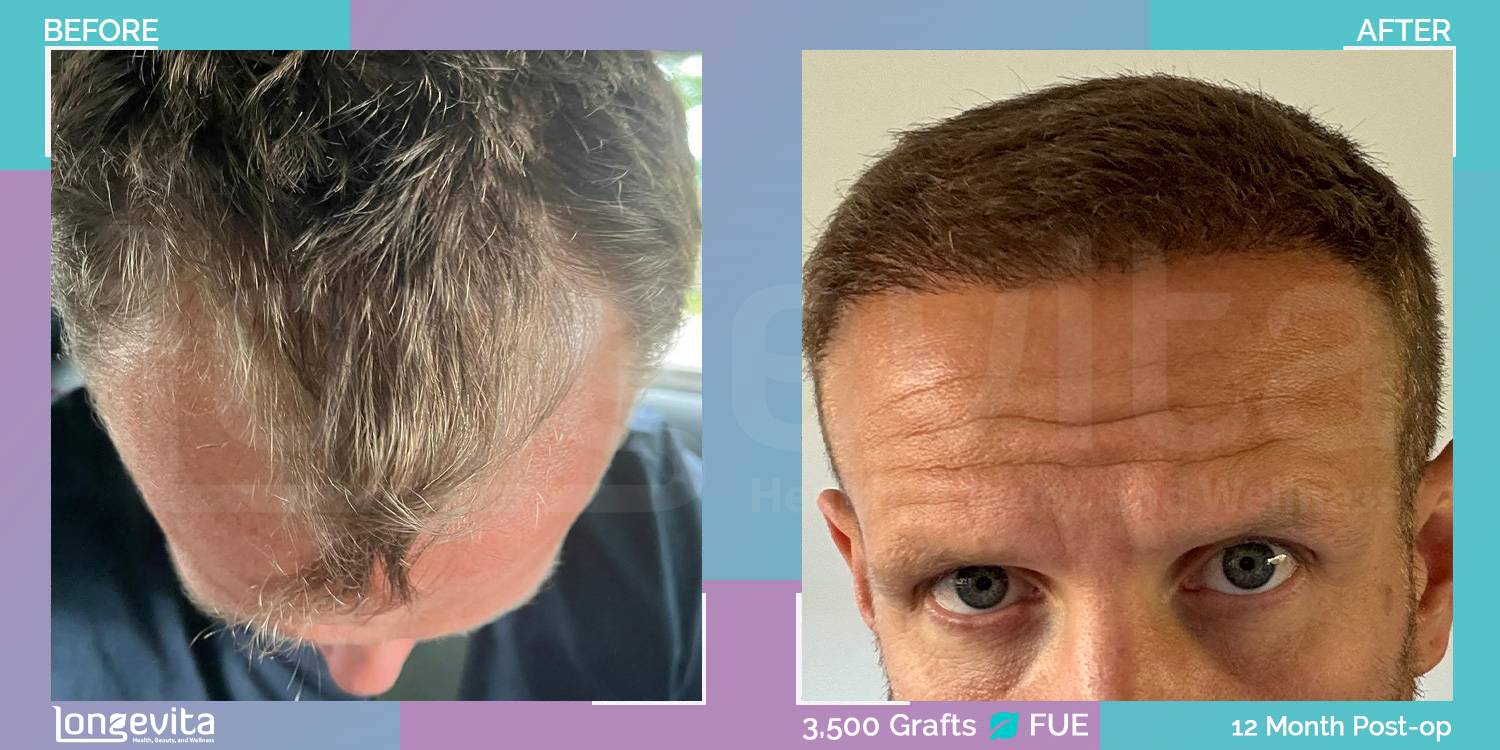 FUE hair transplant before and after, 3500 grafts, 2 zones covered, 30s male patient