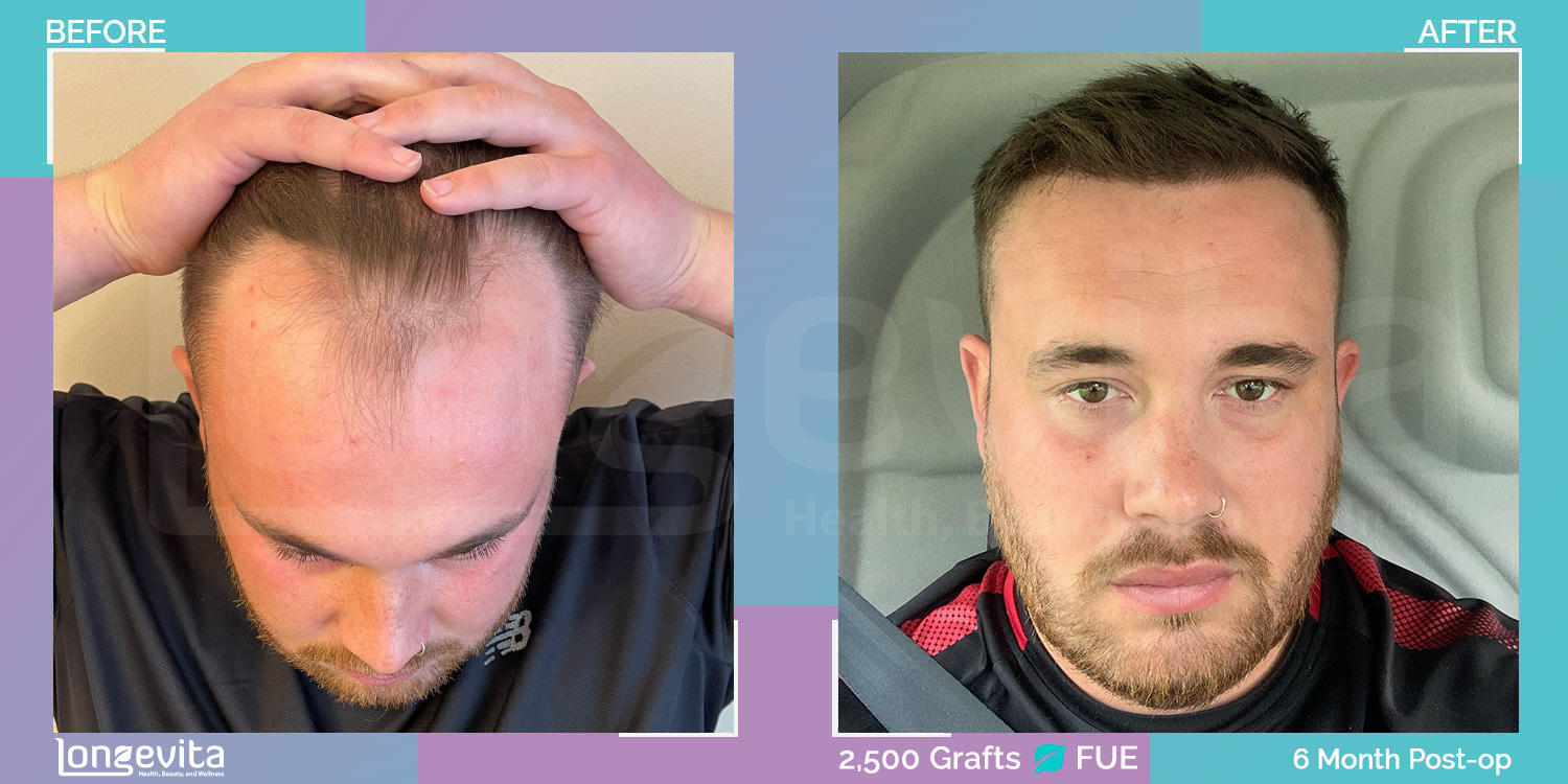 FUE hair transplant before and after, 2500 grafts, 2 zones covered, 20s male patient