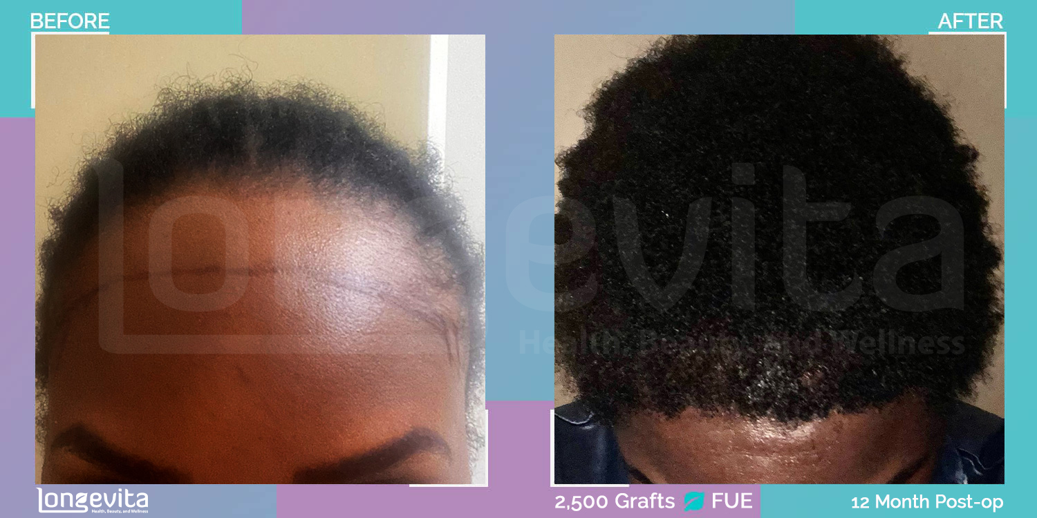 FUE hair transplant before and after, 2500 grafts, 2 zones covered, 40s female patient