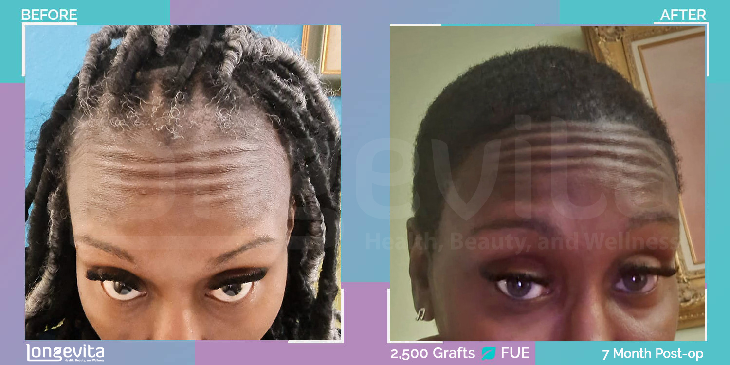 FUE hair transplant before and after, 2500 grafts, 2 zones covered