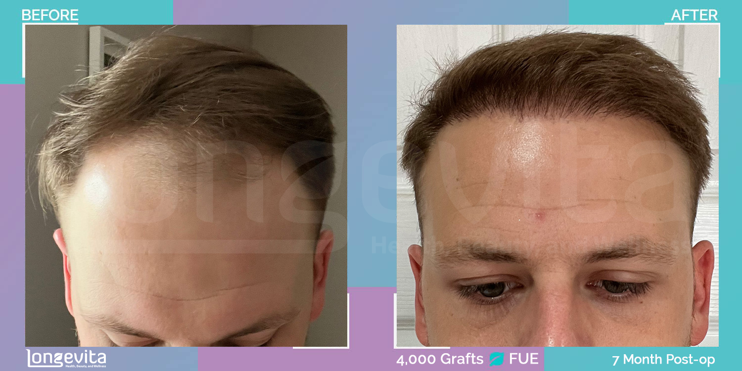 FUE hair transplant before and after, 4000 grafts, 3 zones covered, 20s male patient