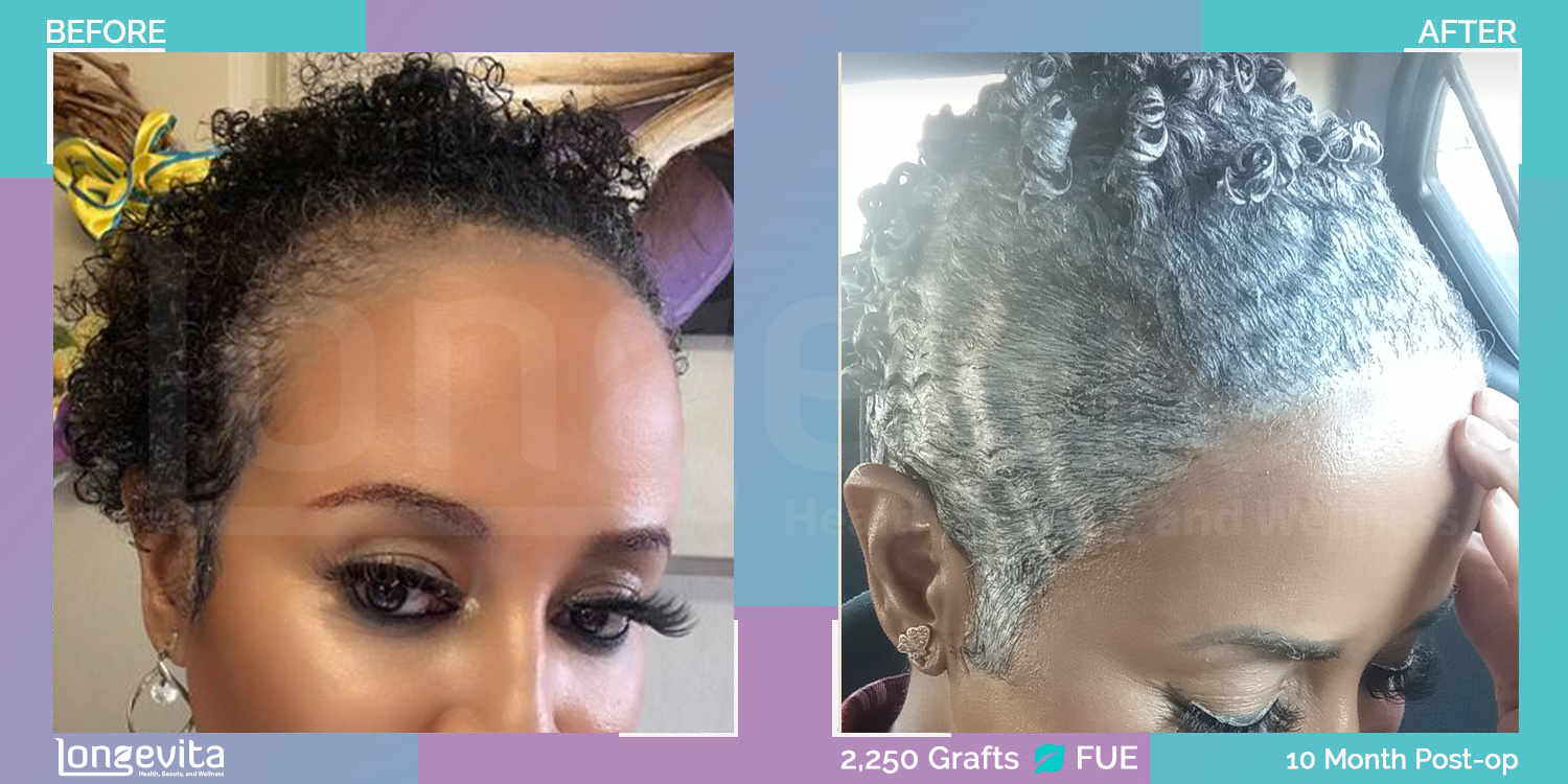 FUE hair transplant before and after, 2250 grafts, 2 zones covered, 50s female patient