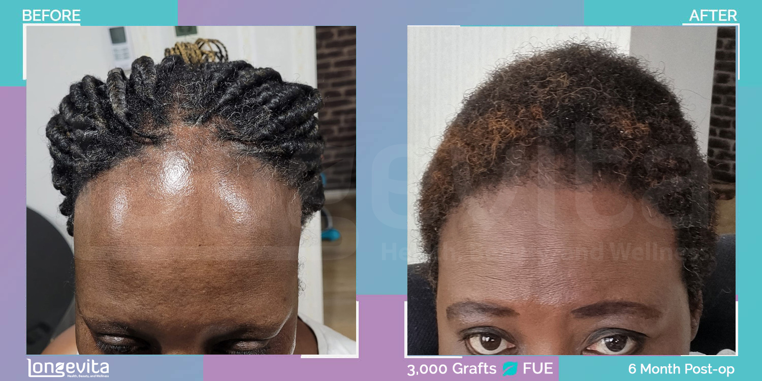 FUE hair transplant before and after, 3000 grafts, 2 zones covered, 40s female patient