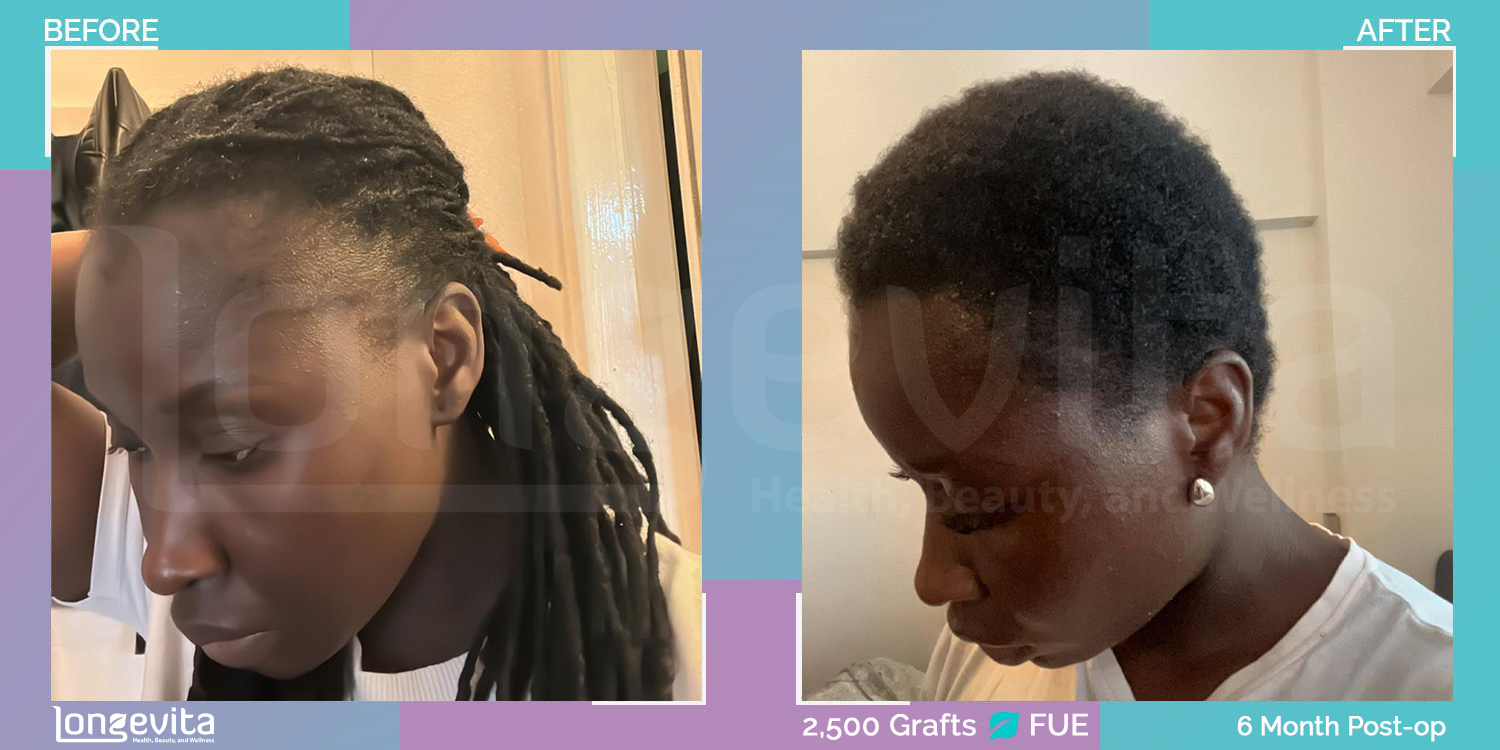 FUE hair transplant before and after, 2500 grafts, 2 zones covered, 30s female patient