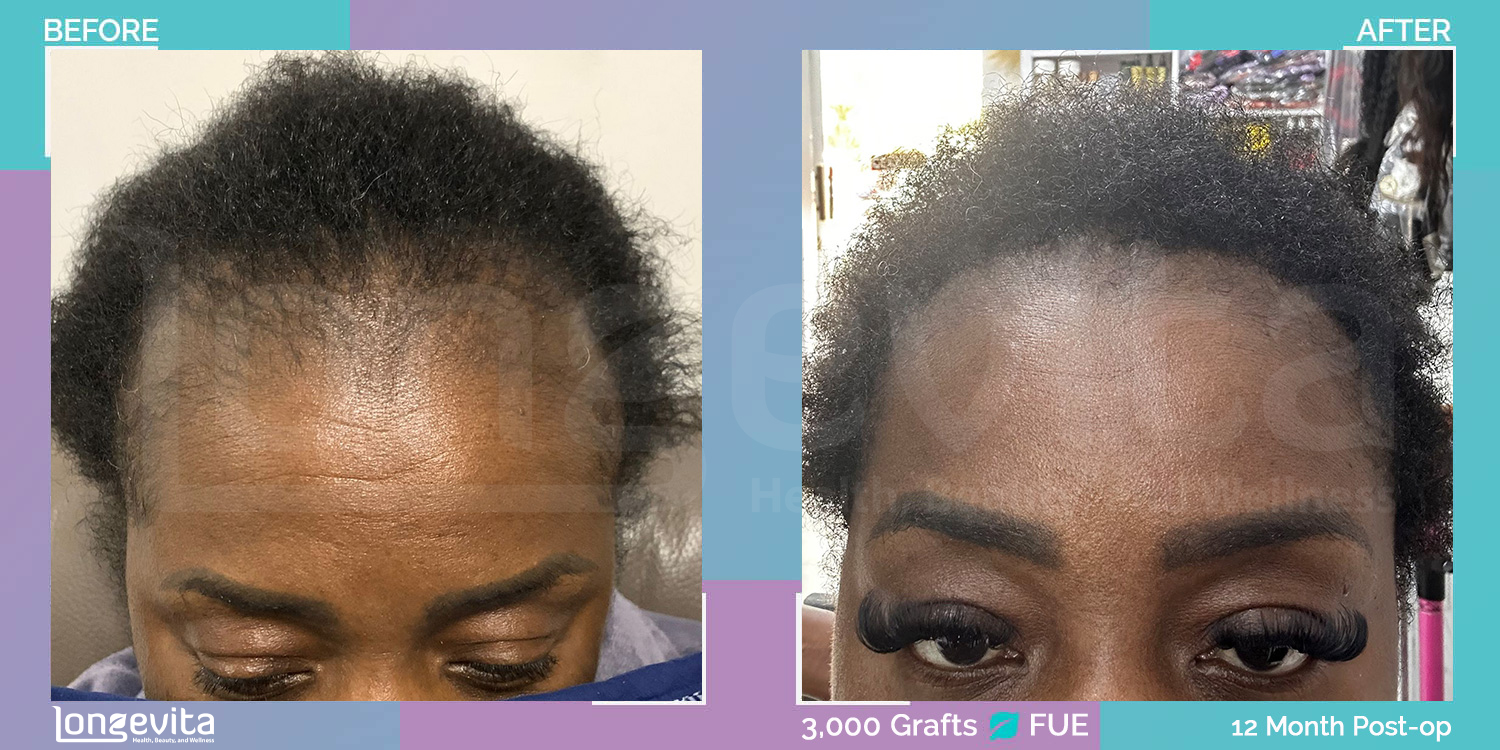 FUE hair transplant before and after, 3000 grafts, 2 zones covered, 50s female patient