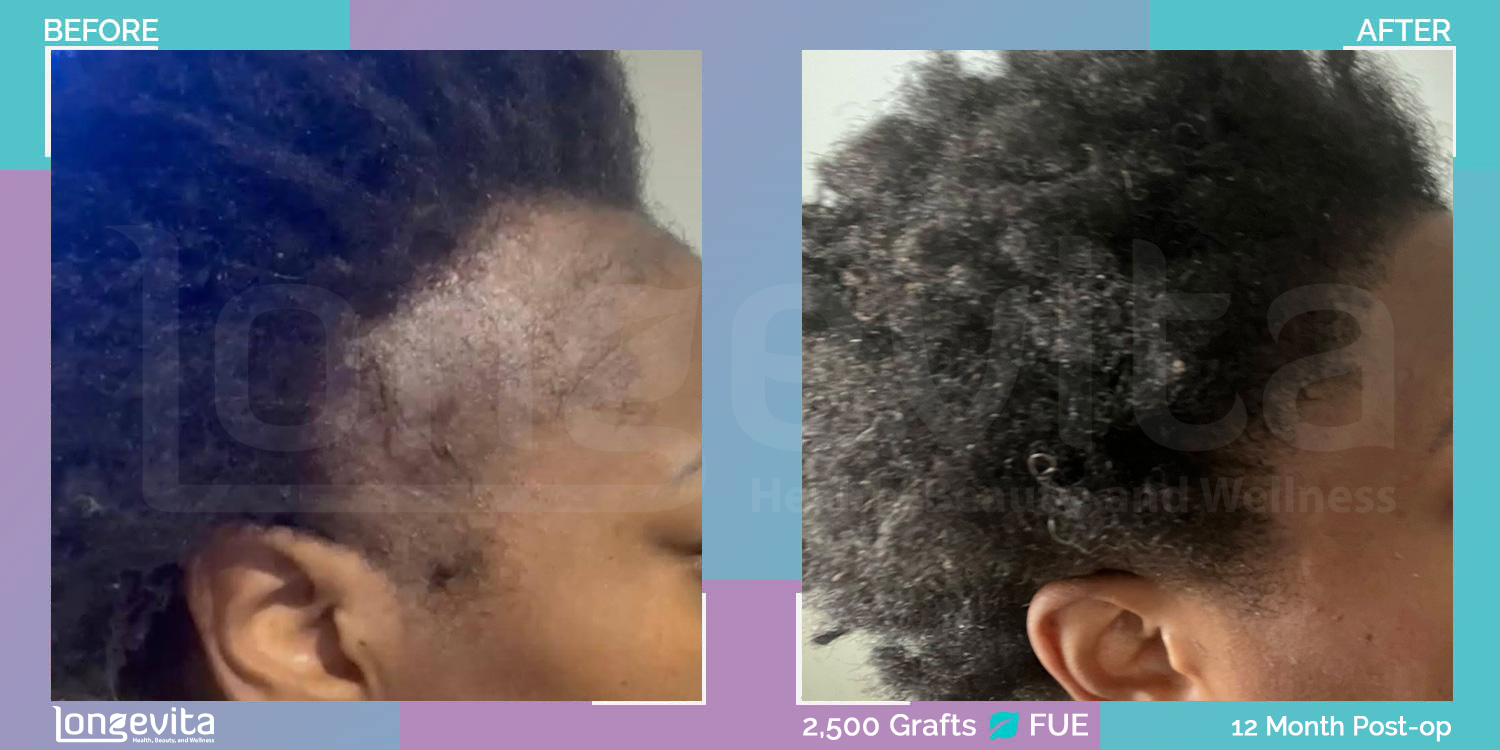 FUE hair transplant before and after, 2500 grafts, 2 zones covered, 30s female patient