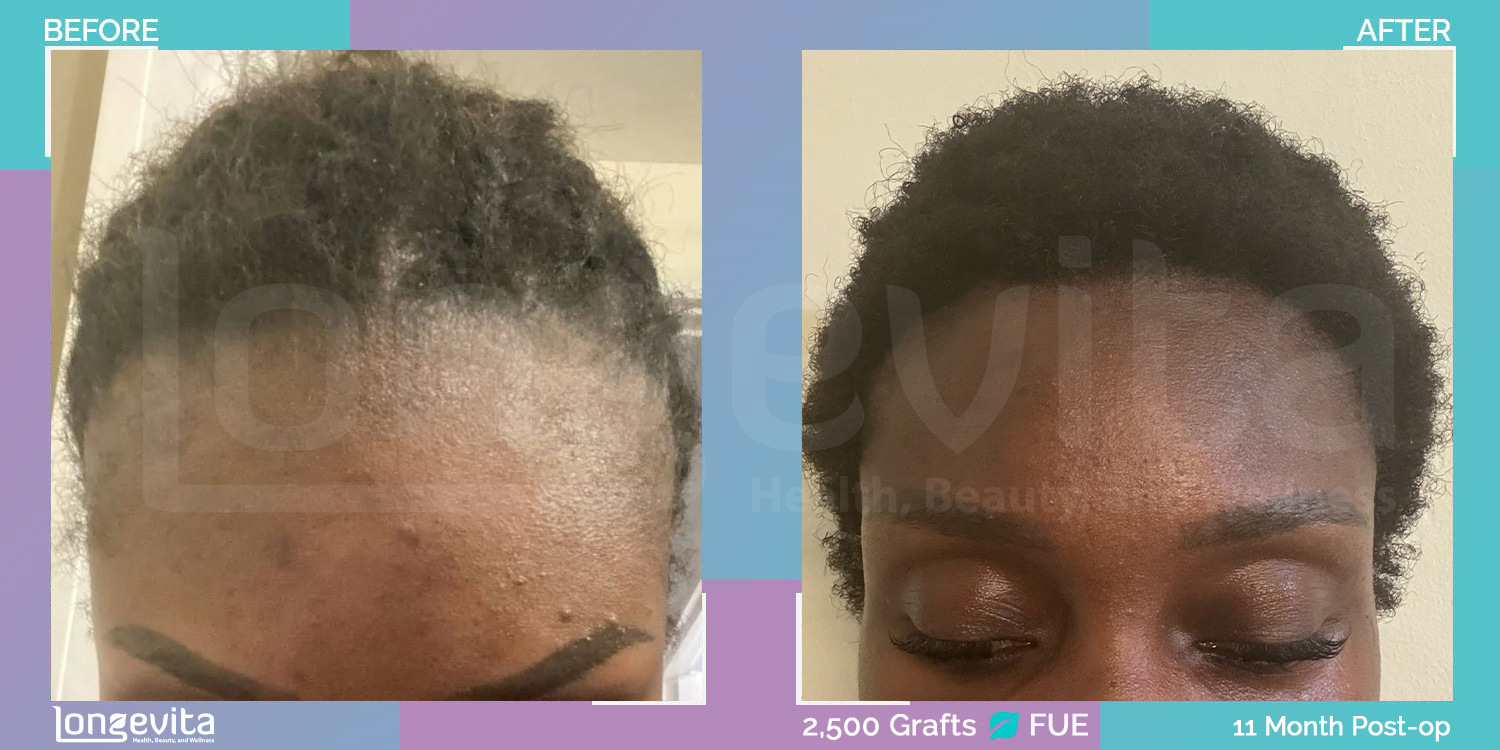 FUE hair transplant before and after, 2500 grafts, 2 zones covered, 30s female patient