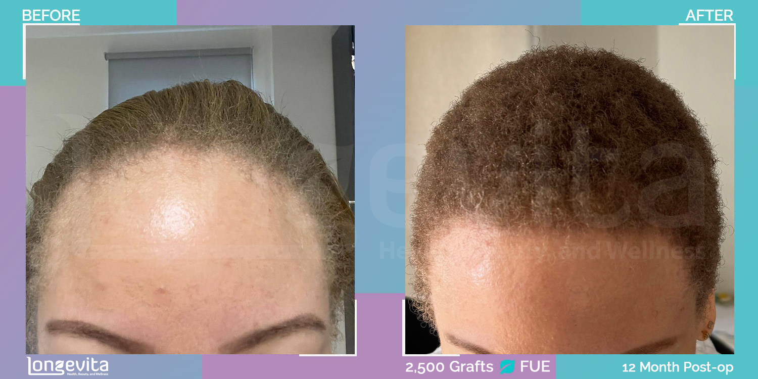 FUE hair transplant before and after, 2500 grafts, 2 zones covered, 30s female patient
