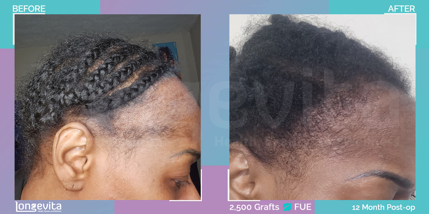FUE hair transplant before and after, 2500 grafts, 2 zones covered, 40s female patient